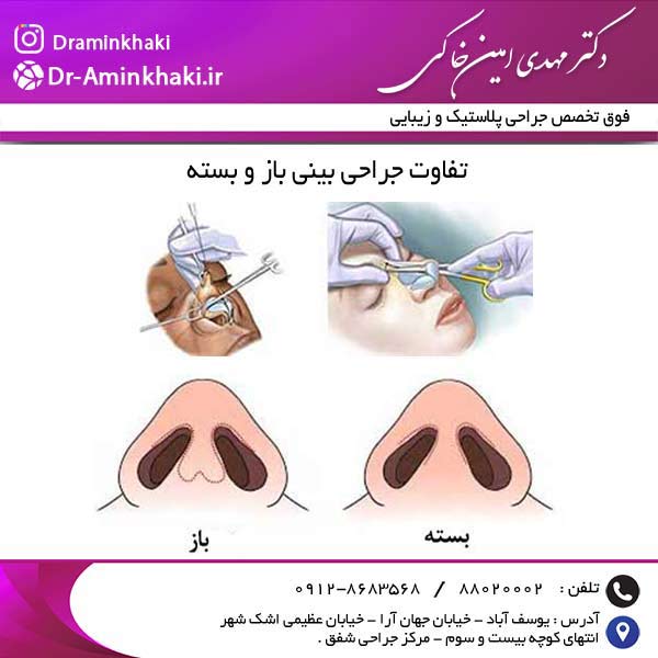 تفاوت جراحی بینی باز و بسته