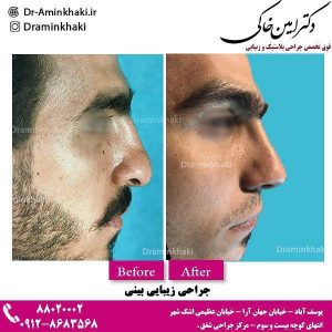 جراحی بینی در آقایان - دکتر امین خاکی