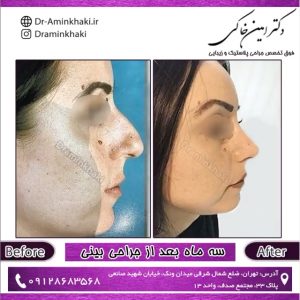 جراحی زیبایی بینی در تهران