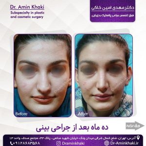 جراحی بینی گوشتی - دکتر امین خاکی