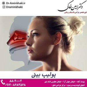 پولیپ بینی - دکتر امین خاکی 