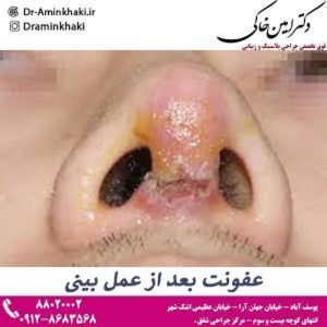 عفونت بعد از عمل بینی - دکتر مهدی امین خاکی 