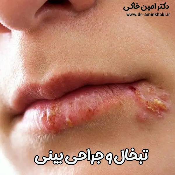 عکس تبخال و جراحی بینی - دکتر امین خاکی